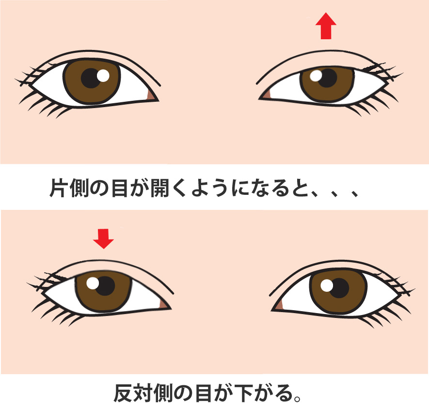 へリングの法則　眼瞼下垂