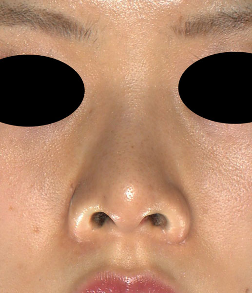 正面　1ヶ月後　シモタケユカ-鼻尖縮小＋軟骨移植
