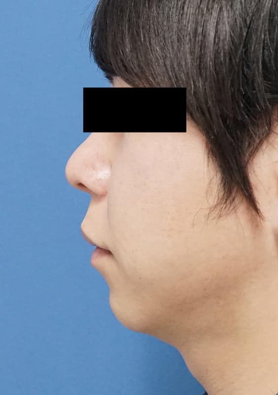 クレヴィエル（アゴ）　1週間後のBefore写真