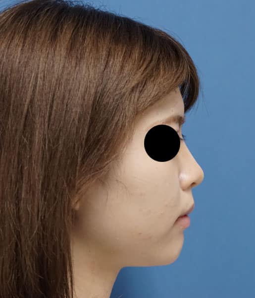 クレヴィエル（鼻・アゴ）　1週間後のAfterの写真