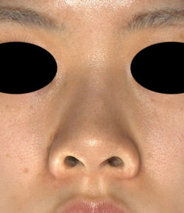 正面　術前　シモタケユカ-鼻尖縮小＋軟骨移植