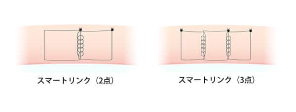 スマートリンク　二重埋没法　２点　３点