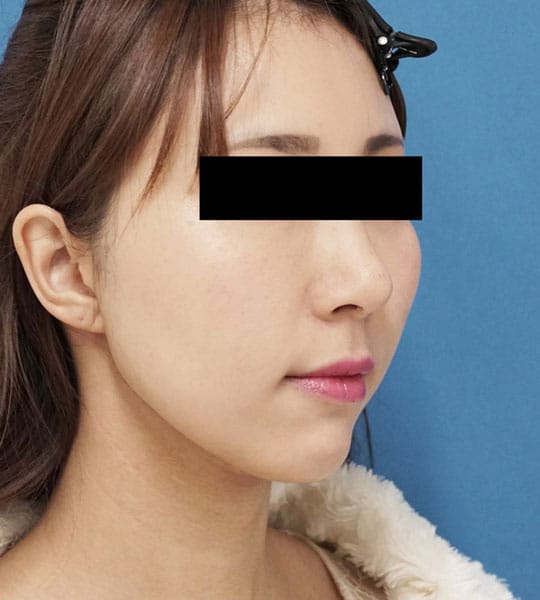 クレヴィエル（アゴ）　1週間後のAfterの写真