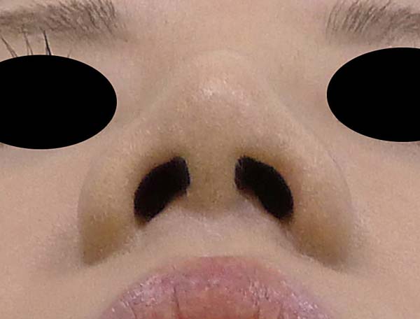 団子鼻をすっきり　鼻尖形成（3D法）　1か月後のAfterの写真