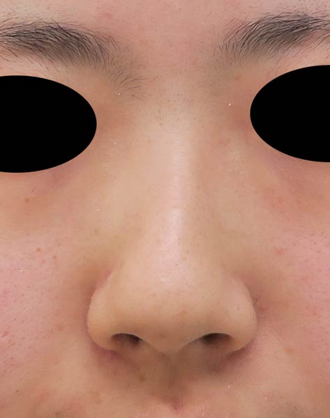 団子鼻をすっきり　鼻尖形成（3D法）　1か月後のBefore写真