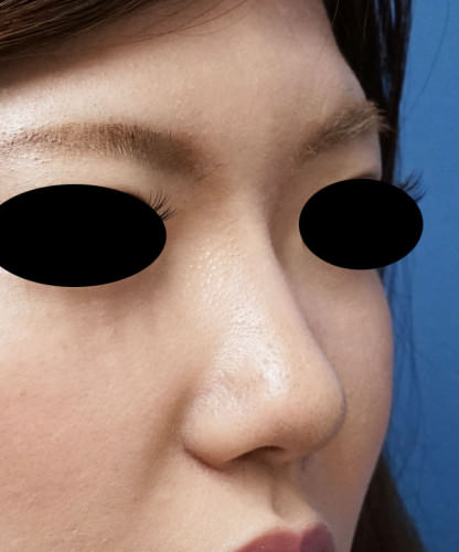クレヴィエル（鼻）　１週間後のAfterの写真