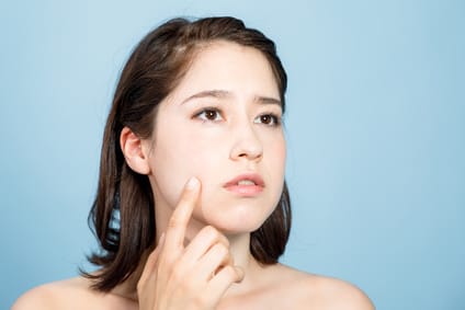 ニキビ跡が目立つ時の改善方法をご紹介