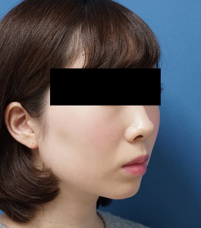 クレヴィエル（アゴ）　1週間後のBefore写真