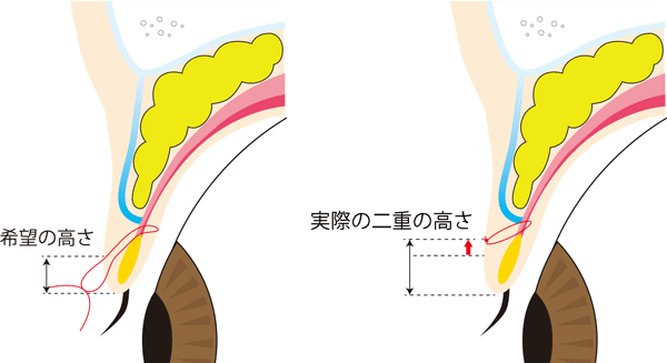 挙筋法で二重幅が広くなりやすい理由