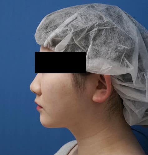 美容外科スタッフさん脂肪吸引（ホホ・ホホ骨・アゴ下）　３か月後のAfterの写真