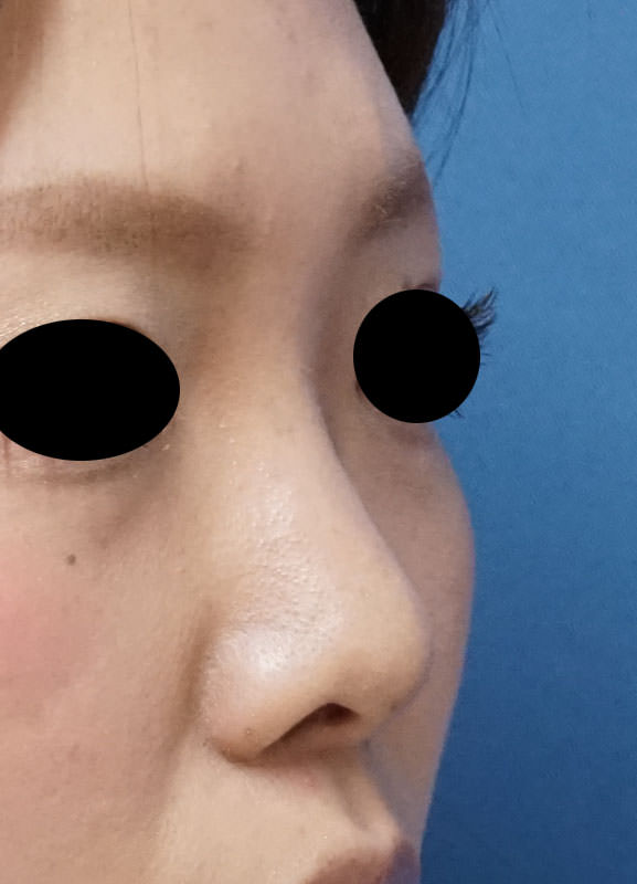 クレヴィエル（鼻根）　1週間後のBefore写真