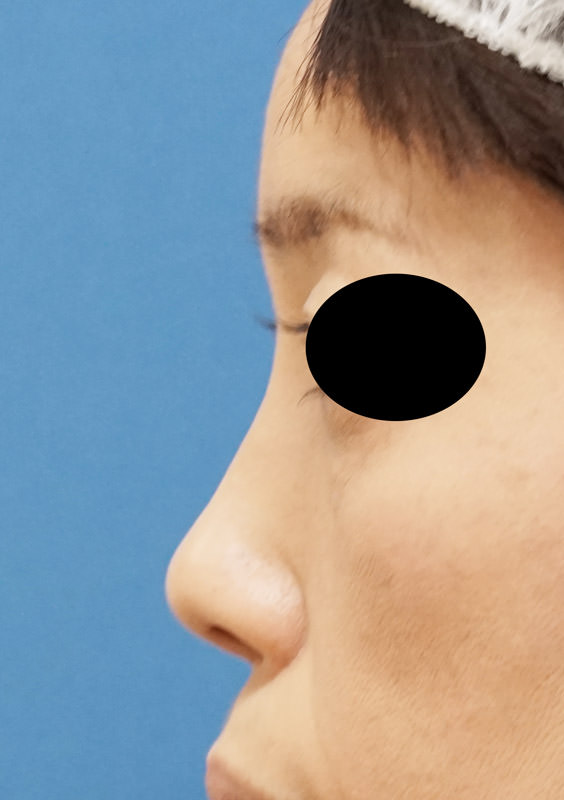 クレヴィエル（鼻）　1週間後のBefore写真