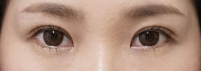 もとびアイゴールド　手術前～3ヶ月後の経過のAfterの写真