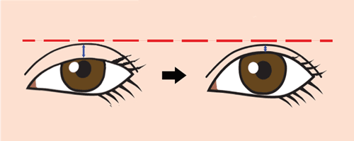 眼瞼下垂術で二重狭くなる