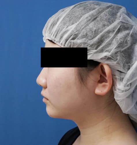 美容外科スタッフさん脂肪吸引（ホホ・ホホ骨・アゴ下）　３か月後のBefore写真