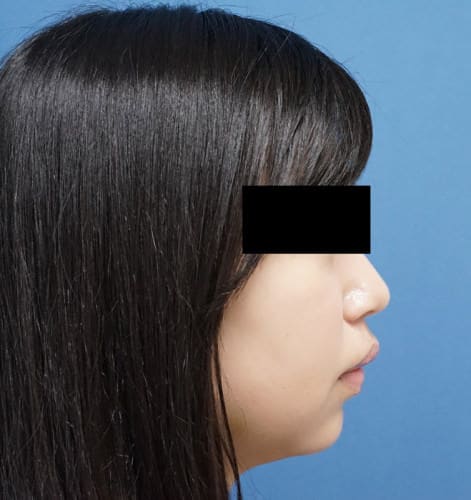 クレヴィエル（鼻・アゴ）　1週間後のAfterの写真