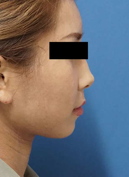 クレヴィエル(アゴ）　1週間後のBefore写真