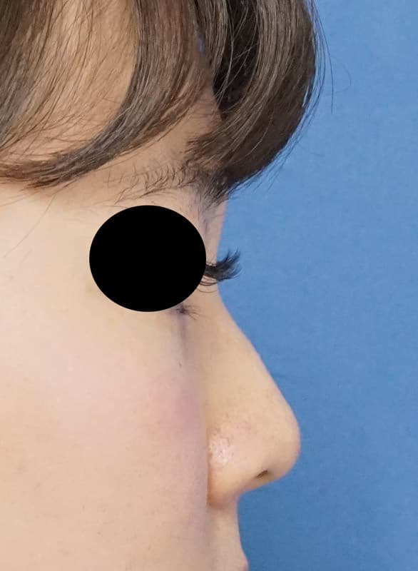 クレヴィエル(鼻根）1週間後のBefore写真