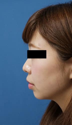 ホホ・アゴ脂肪吸引、強力小顔ボトックス　1ヵ月後のAfterの写真