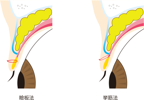 瞼板法と挙筋法の糸のかけ方