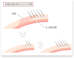 眉下切開の毛包斜切開