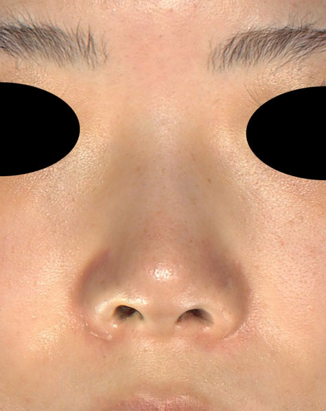 鼻ヒアルロン酸（クレヴィエルコントア）　1週間後のBefore写真