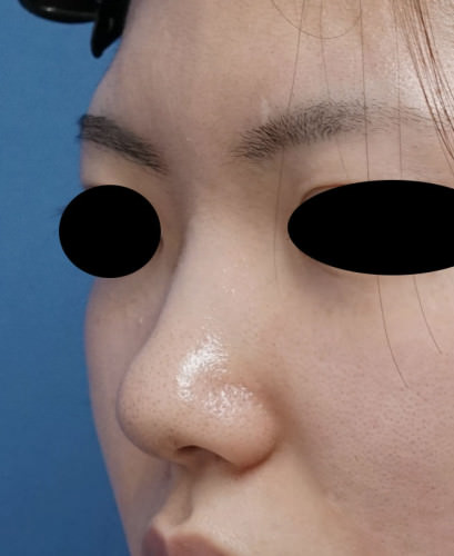 クレヴィエル（鼻）　１週間後のBefore写真