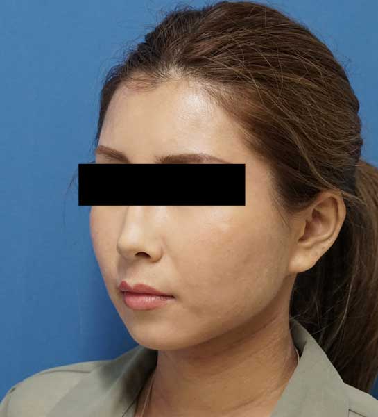 クレヴィエル(アゴ）　1週間後のBefore写真