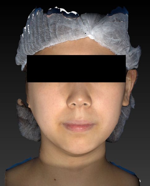 鼻尖縮小＋軟骨移植＋ストラット、鼻翼縮小（内＋外）　３ヶ月後　正面のBefore写真