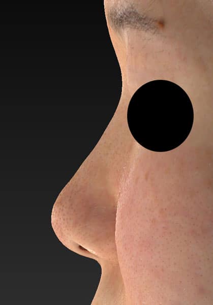 鼻尖縮小、鼻尖軟骨移植　1か月後のBefore写真