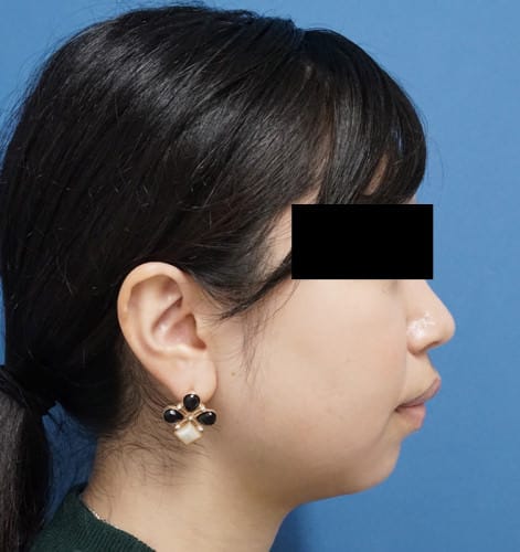 クレヴィエル（鼻・アゴ）　1週間後のBefore写真