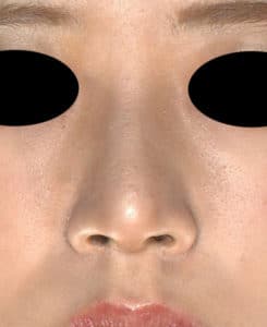 鼻尖縮小（3Ｄ法）、ストラット、軟骨移植　3ヶ月後のAfter写真