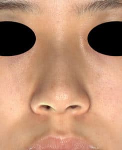 鼻尖縮小＋軟骨移植＋ストラット、鼻翼縮小（内＋外）　３ヶ月後　正面のBefore写真