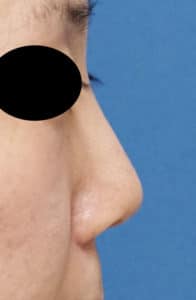 鼻尖縮小３Ｄ法、耳介軟骨移植　3ヶ月後のBefore写真