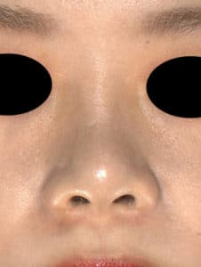 鼻尖縮小（３Ｄ法）、鼻翼縮小(内側・flap法)、Ｉ型プロテーゼ　半年後のAfterの写真