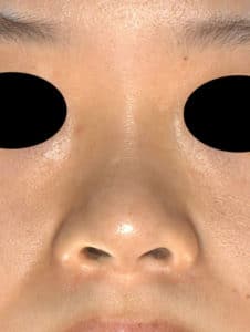 鼻尖縮小（３Ｄ法）、鼻翼縮小(内側・flap法)、Ｉ型プロテーゼ　半年後のBefore写真