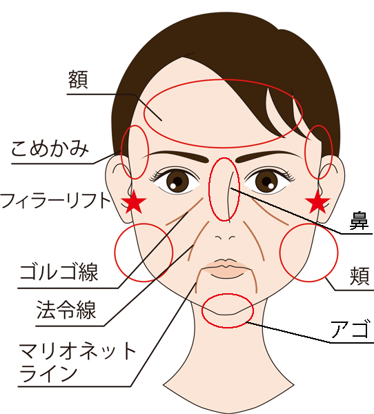 ジュビダームボリューマの注入部位