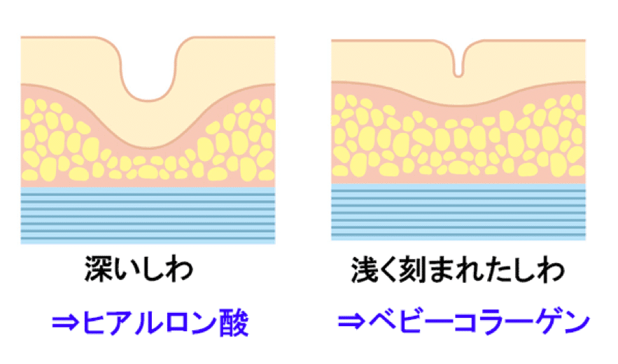 ヒアルロン酸とベビーコラーゲンのそれぞれに適したしわのイメージ