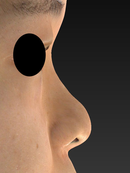 右側面　手術前　プロテ＋鼻尖縮小(3D法)＋鼻翼縮小(内側・flap法)