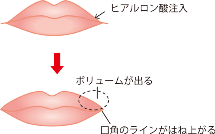 ヒアルロン酸で口角を上げるイメージ