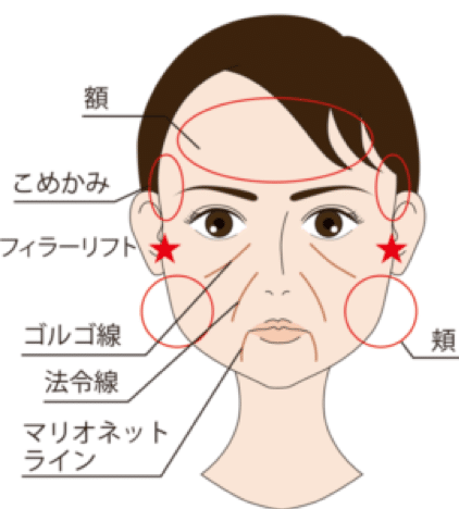 ジュビダームボリフトの注入部位