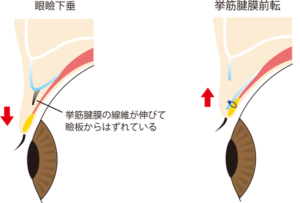 挙筋前転術の解説