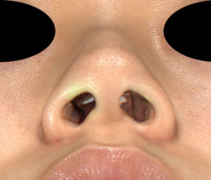 下から　術前　鼻尖縮小(3D法)＋軟骨移植