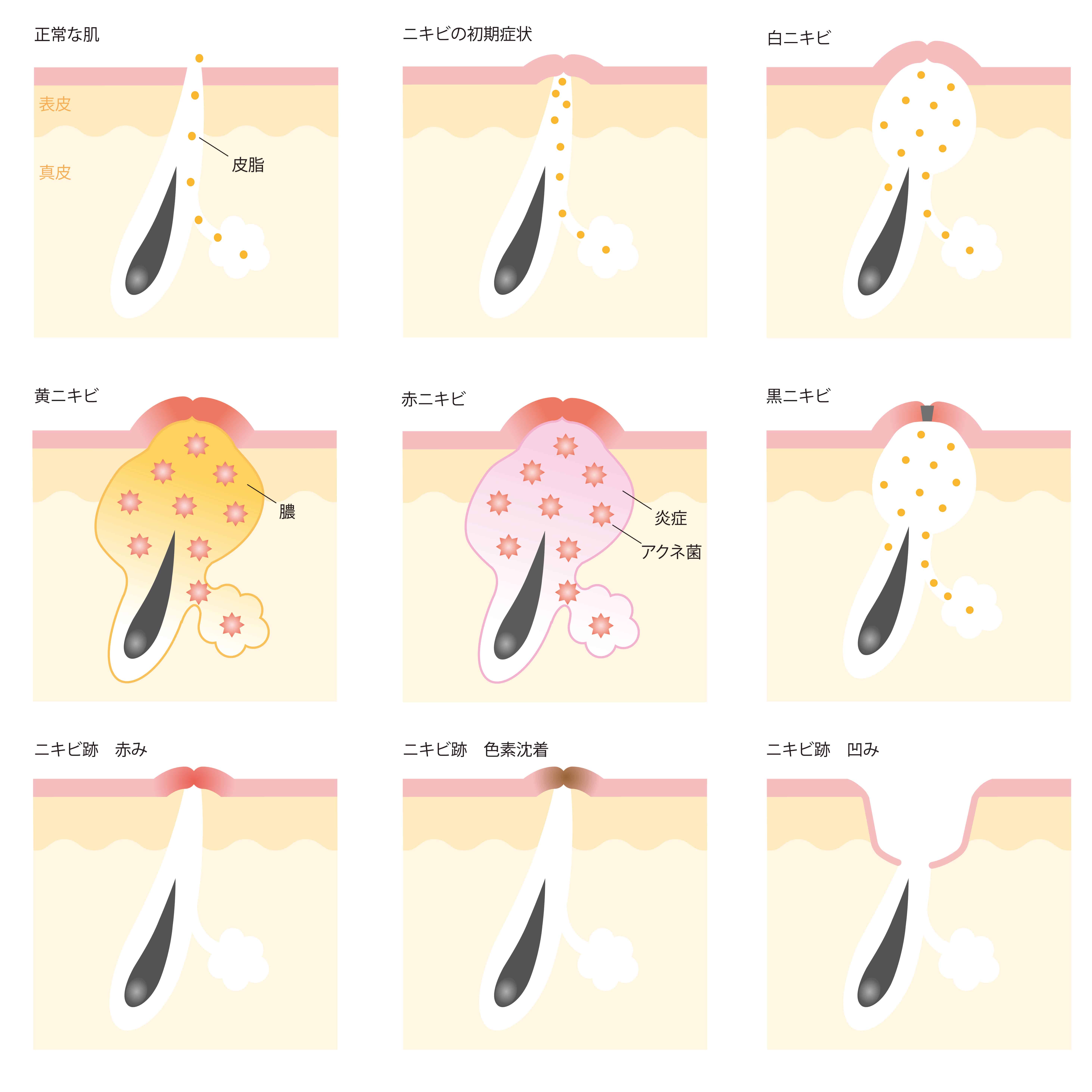 いろいろな種類のニキビ