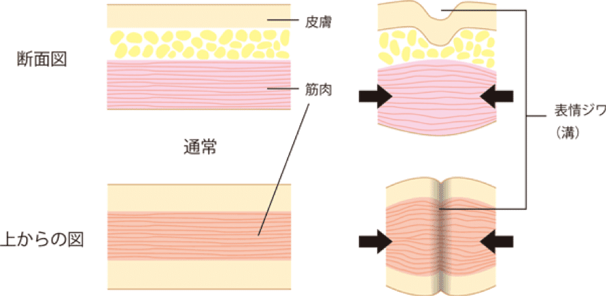 表情ジワの断面図