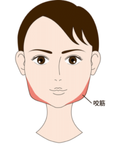 エラボトックスで減らす咬筋