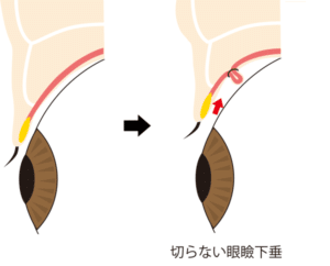 切らない眼瞼下垂の施術方法の解説