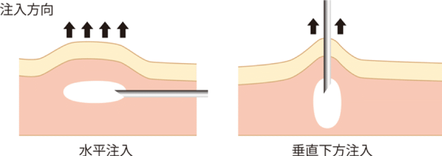 水平注入、垂直注入のイメージ