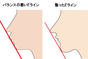 悪いEラインと良いEラインの比較