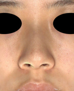 正面　術前　鼻尖縮小(3D法)＋軟骨移植